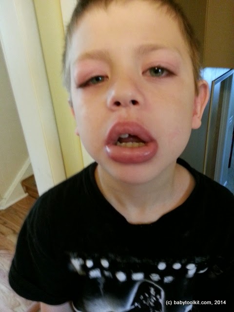 allergic to benadryl allergic to benadryl